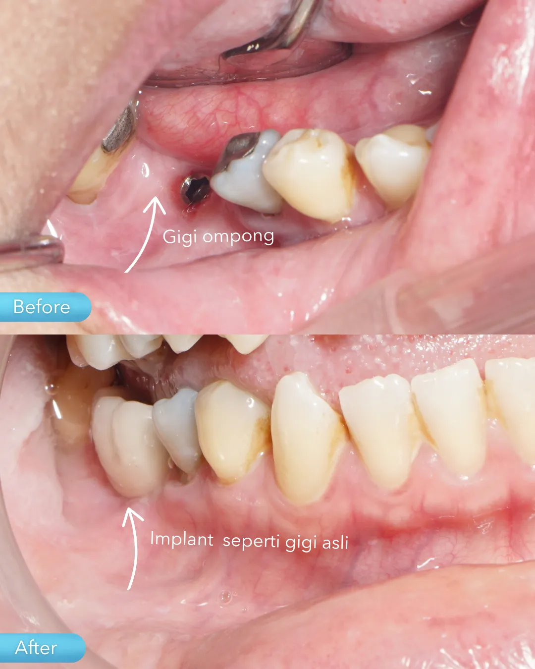 Dental implant result
